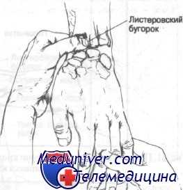 переломы костей запястья