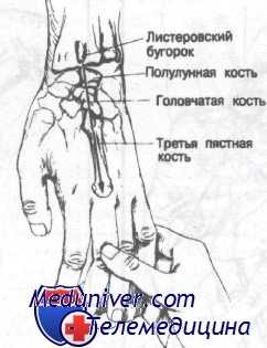 переломы костей запястья
