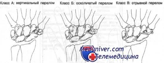 переломы костей запястья
