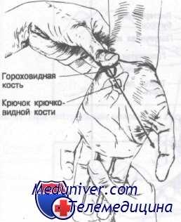 переломы костей запястья