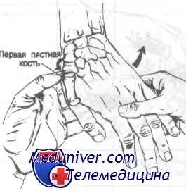 переломы костей запястья