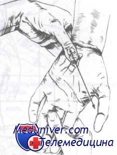 переломы костей запястья