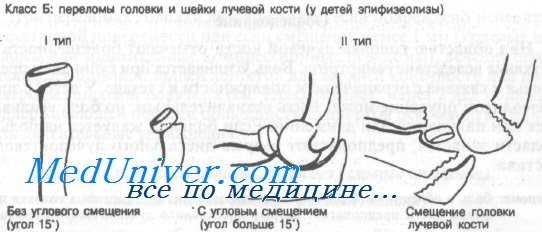 перелом головки и шейки лучевой кости