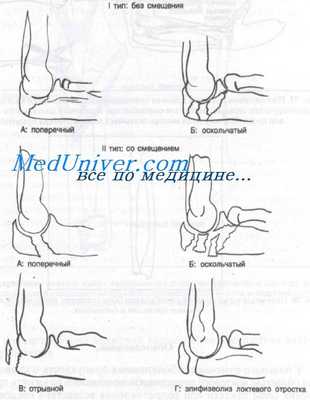 перелом локтевого отростка