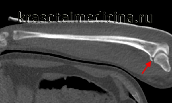 КТ локтевого сустава. Перелом венечного отростка локтевой кости.