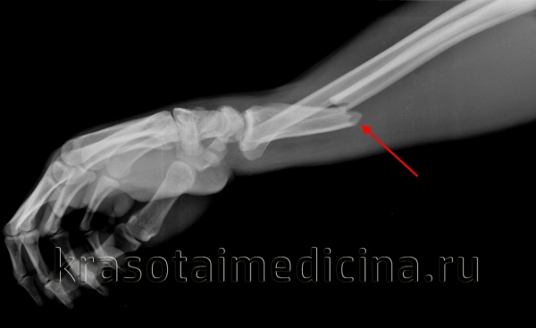 Перелом локтевого отростка