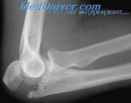 перелом локтевого отростка