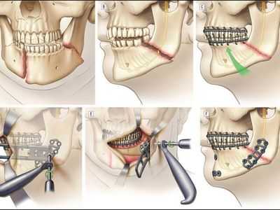 Схема лечения перелома челюсти