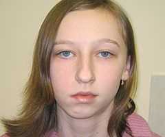 Ассиметрия челюсти после перелома