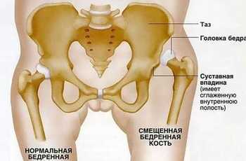 В медицине выделяется огромное количество патологий тазобедренного сустава самых разных этиологий. На третьем месте по распространенности стоит эпифизеолиз головки бедренной кости. Данная патология встречается в детском и подростковом возрасте.
