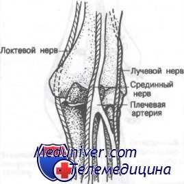 перелом дистального отдела лучевой кости