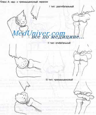 надмыщелковые переломы плечевой кости