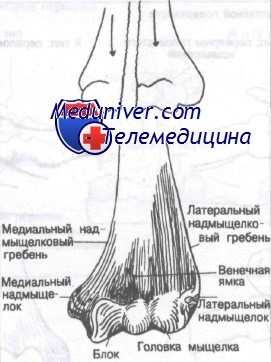 перелом дистального отдела лучевой кости