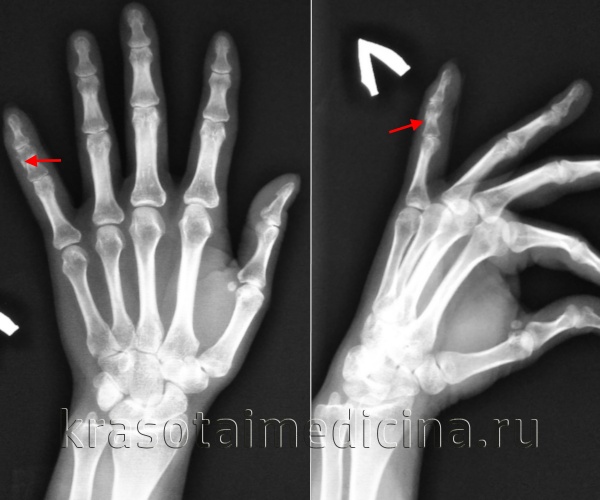 Переломы костей стопы и пальцев у детей