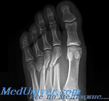 перелом плюсневых костей