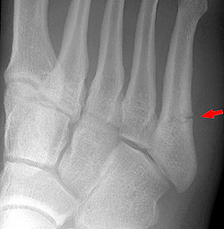 Рентгенограмма при переломе V плюсневой кости