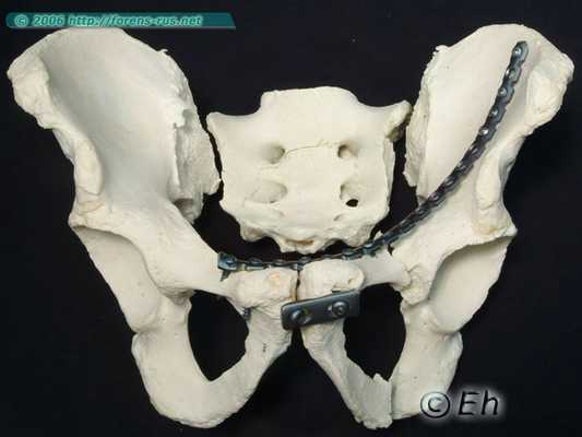 Пролеченная травма таза после переезда колесом легкового автомобиля