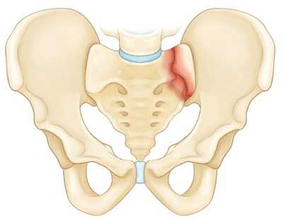 Изолированный перелом крестца