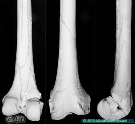 Перелом бедренной кости при переезде колёсами автомобиля