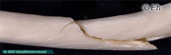 Прямой разгибательный перелом ребра