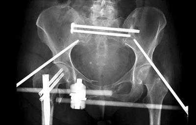 стабилизации костей таза