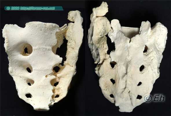 Переезд крестца колёсами автомобиля