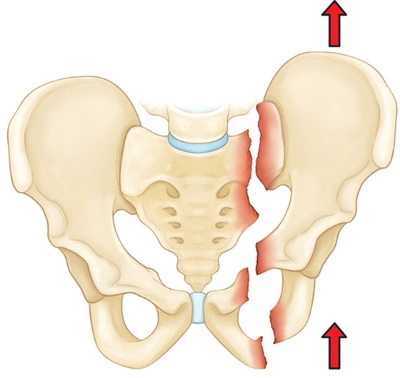 Вертикально-нестабильный перелом