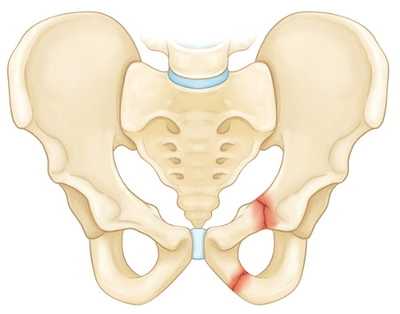 Перелом верхней и нижней ветвей лонной кости