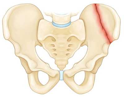 Перелом крыла подвздошной кости
