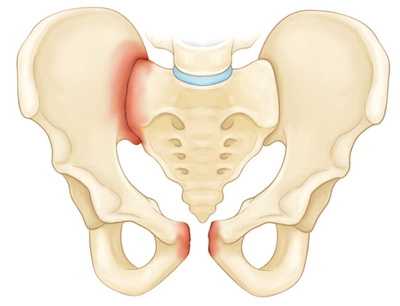 Повреждение в результате передне-задней компрессии таза