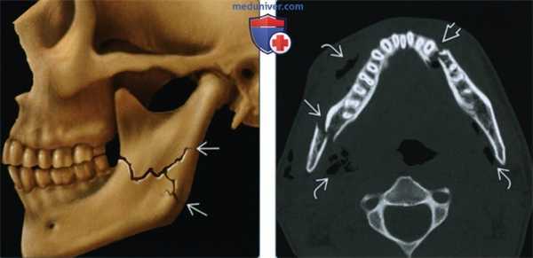 Переломы нижней челюсти - лучевая диагностика