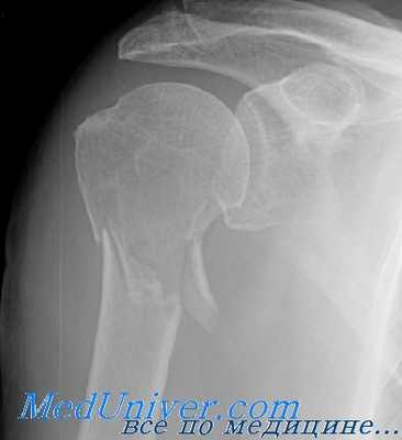 перелом хирургической шейки плечевой кости