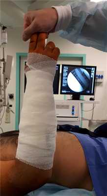 операция остеосинтеза предплечья в средней трети