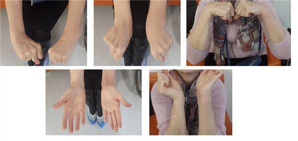 после операции при переломе луча в типичном месте