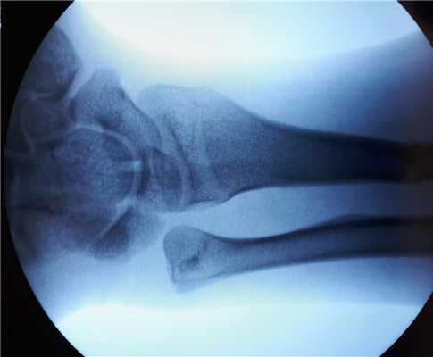 разрыв радиоульнарного сочленения