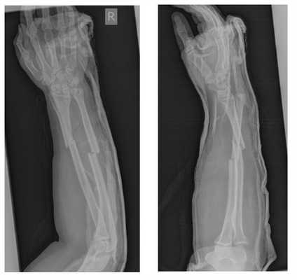 перелом предплечья в средней трети рентген