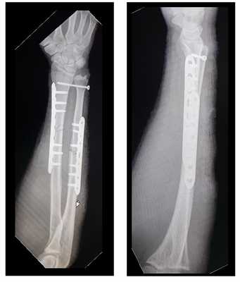 остеосинтез предплечья в средней трети рентген
