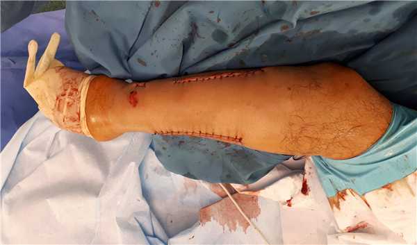 после операции остеосинтеза предплечья