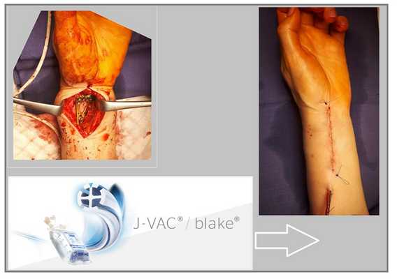 перелом луча в типичном месте дренаж