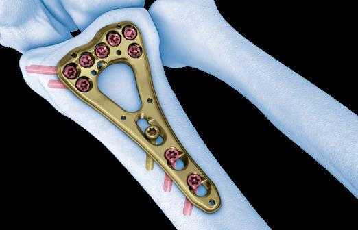 перелом луча в типичном месте пластина