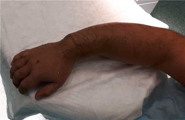 перелом обеих костей предплечья