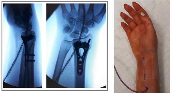 простой перелом луча в типичном месте операция
