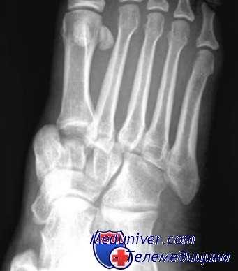 переломы и вывихи стопы