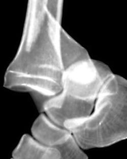 Рентгенограмма при вывихе стопы кзади и переломе наружной лодыжки