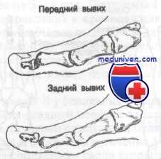 переломы и вывихи пальцев стопы