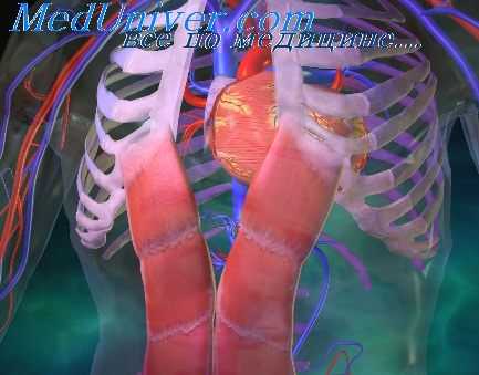 перевязка легочной артерии