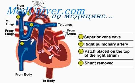 перевязка легочной артерии