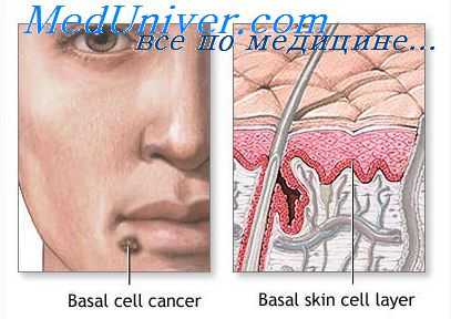 аденокарцинома