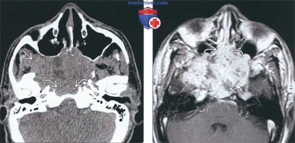Лучевая диагностика аденокистозного рака носа и околоносовых пазух