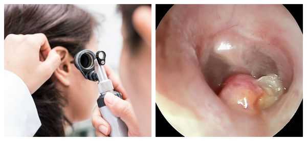 Визуализация полипа с помощью отоскопа